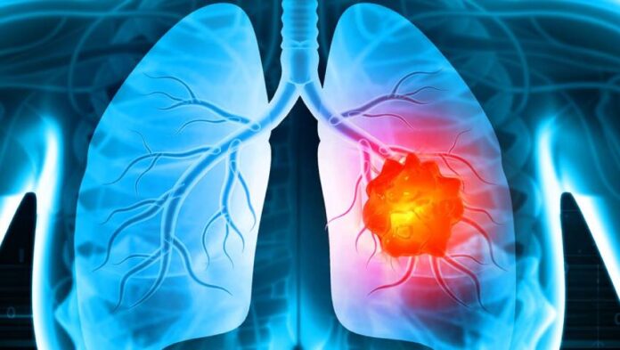 Why-Is-Lung-Cancer-Increasing-in-Never-Smokers_